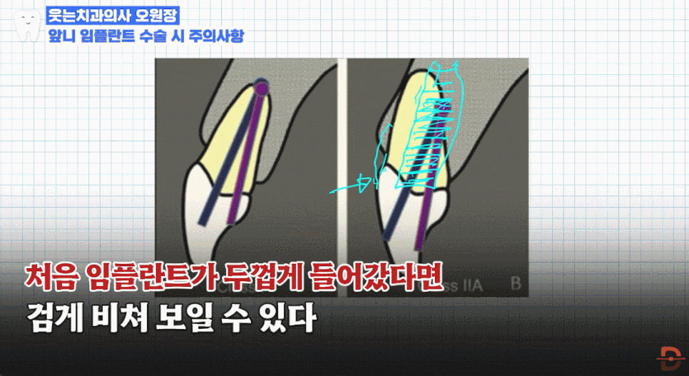 앞니임플란트치과 찾기 전 제발 이 글부터 읽어보세요 관련 이미지 15