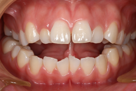 Can Invisalign Correct an Open Bite at a Dental Clinic Near Sinsa Station? image 3