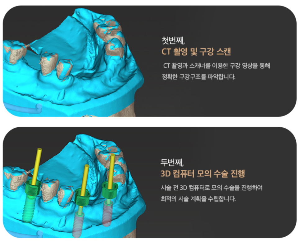 If You Want Your 40s Dental Implant to Last 10 or 20 Years, Check This First image 11