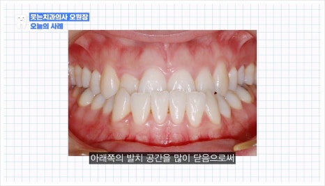주걱턱 교정 VS 양악수술? 교정과 전문의가 답변드립니다 관련 이미지 13