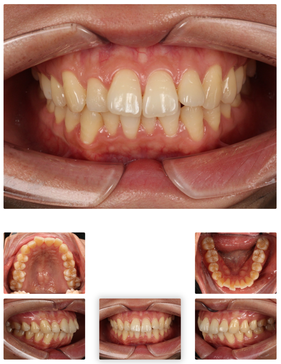 Gap Between the Front Teeth? Don’t Judge It by Front Teeth Partial Orthodontic Reviews Alone image 9