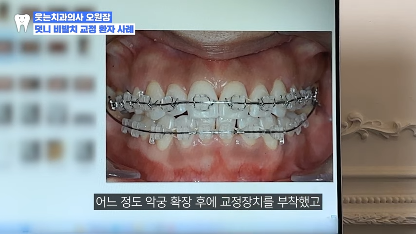 강남치아교정, 치아교정잘하는곳은 정직하게 진료합니다 관련 이미지 5