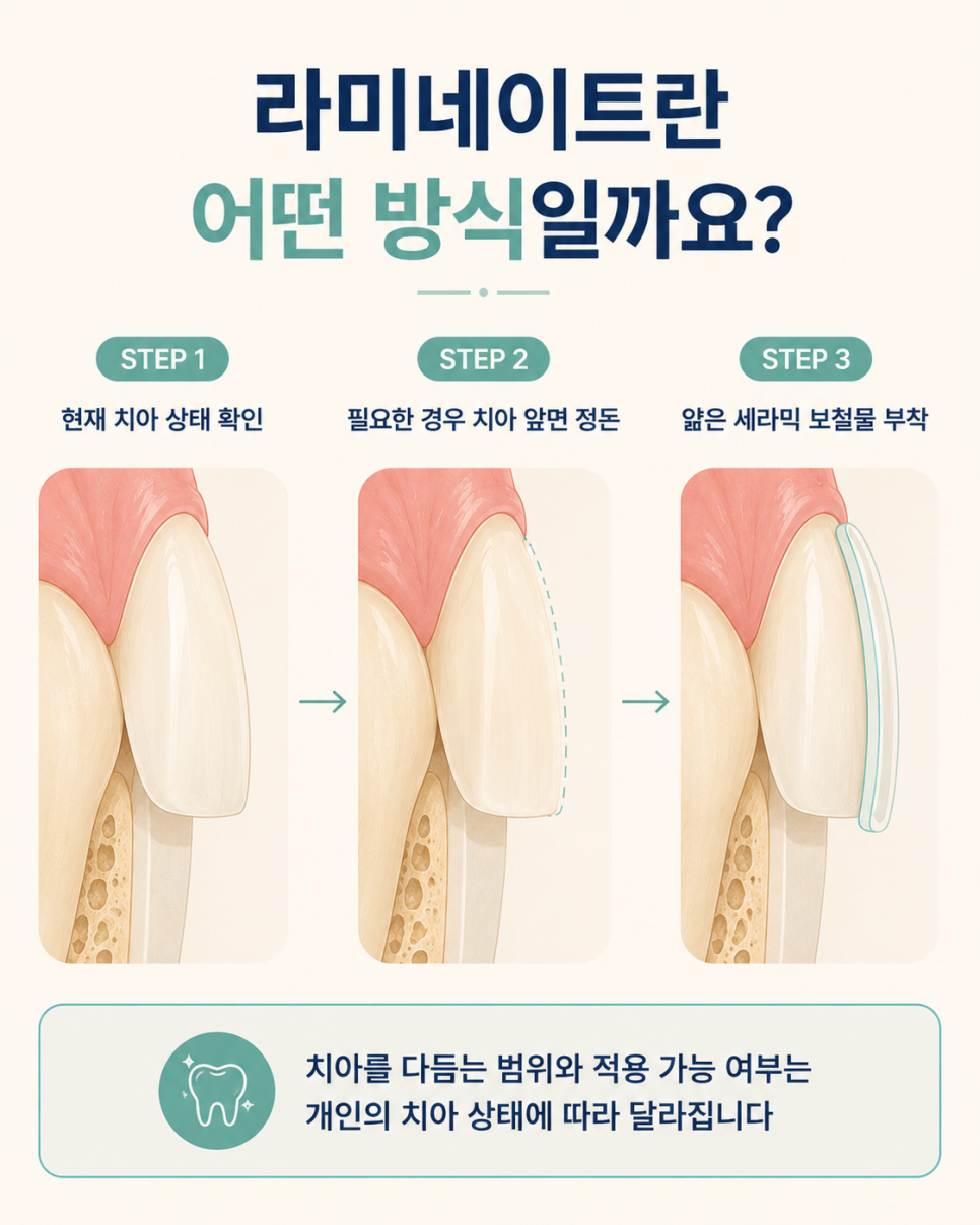 라미네이트란? 앞니 벌어짐 고민, 교정·레진과는 어떻게 다를까 관련 이미지 3