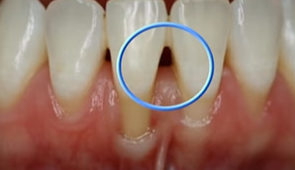 Flossing Order: Before Brushing? After? The Correct Way to Use Dental Floss image 6