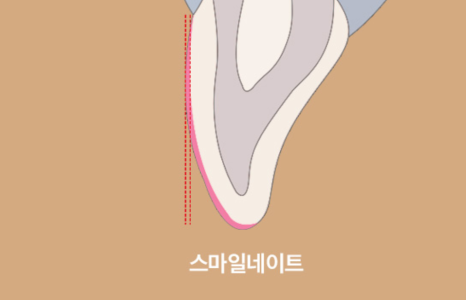 No-Prep Laminates for Teeth: If Done Incorrectly, They Can Make Front Teeth Protrusion Worse image 14