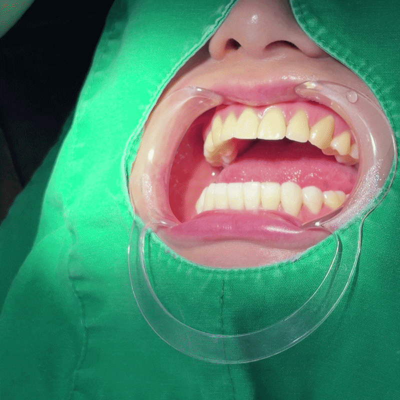 스마일랩핑이란? 무삭제 가능 여부부터 원데이 치료까지 <총정리> 관련 이미지 1