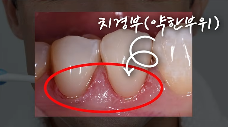 Gum Recession, Tooth Notching: Causes and Solutions <Must Read in 1 Minute> image 4