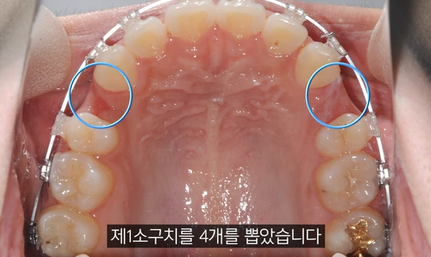 교정 발치 후 식사? 흡연? 운동 주의사항 총정리 관련 이미지 2