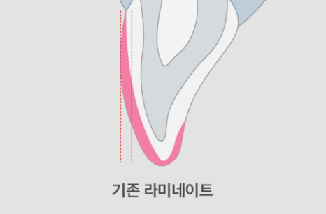 No-Prep Laminates for Teeth: If Done Incorrectly, They Can Make Front Teeth Protrusion Worse image 13