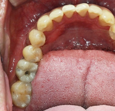 Is Same-Day Implant Possible? What You Must Know Before Implant Surgery image 5