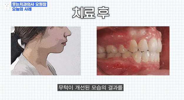 무턱교정 전후, 얼굴라인 달라지고 싶다면 관련 이미지 9