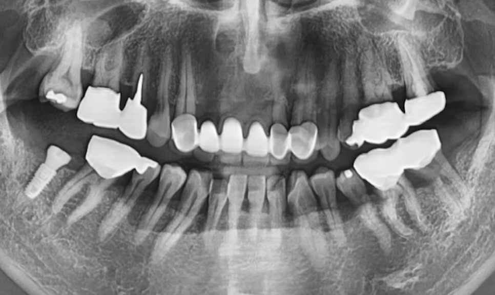 임플란트수술? 발치 즉시 vs 발치 후 임플란트 종류 따져보기 관련 이미지 4