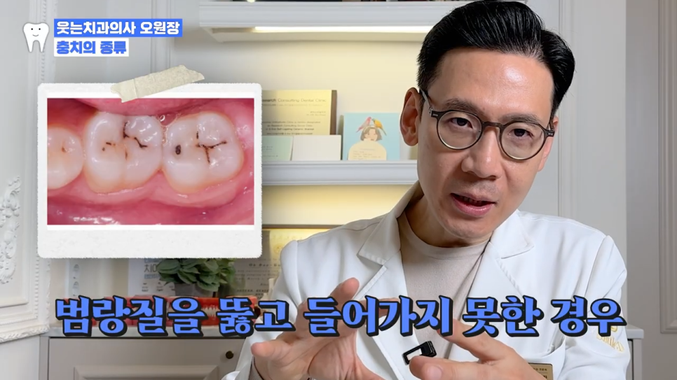 충치 자연치유 어렵기에, 충치단계 치료법 알아두세요 관련 이미지 5
