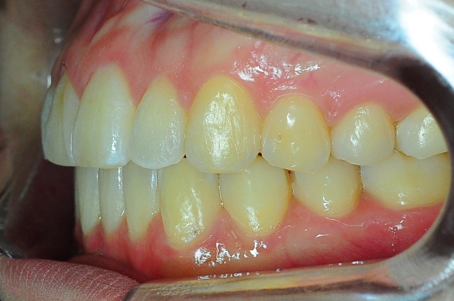 Why Are Invisalign Screws Placed, and How Much Do They Hurt? image 4
