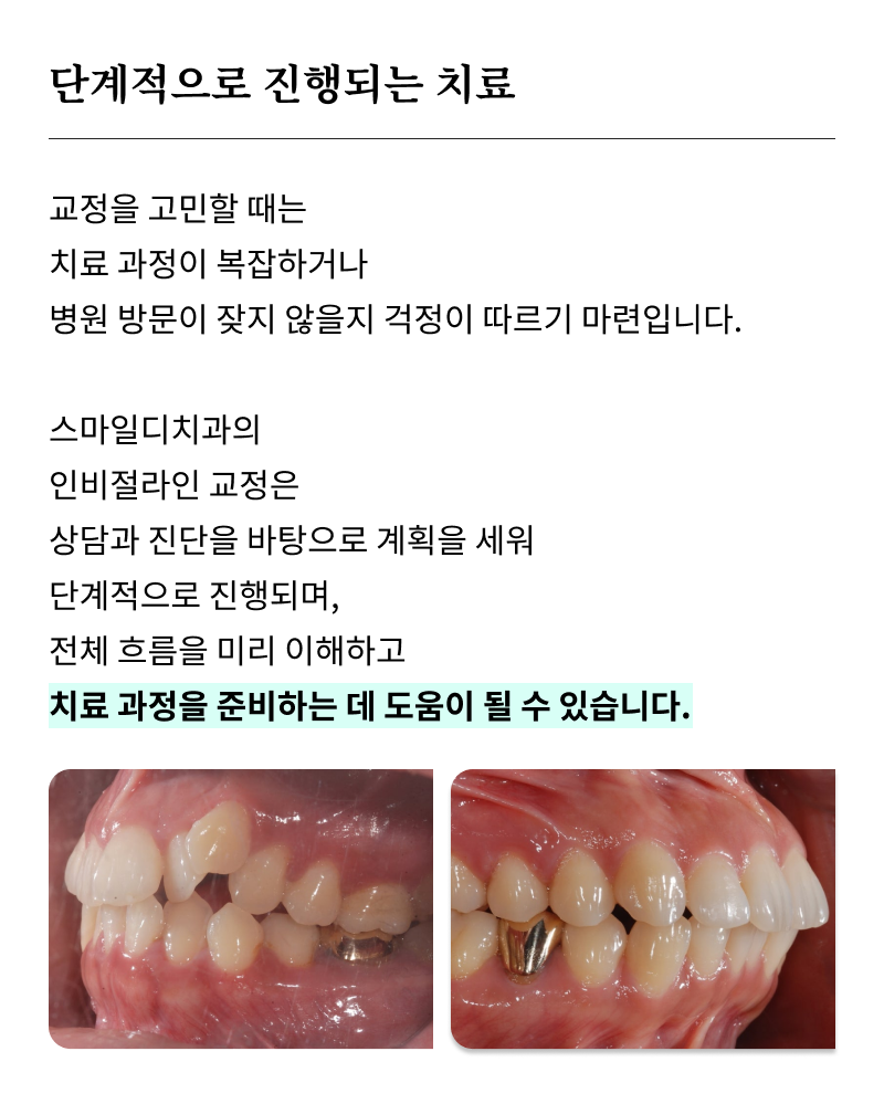 40대 치아 교정 고민 중이라면? 부담 줄이고 효율 높이는 선택법 관련 이미지 18