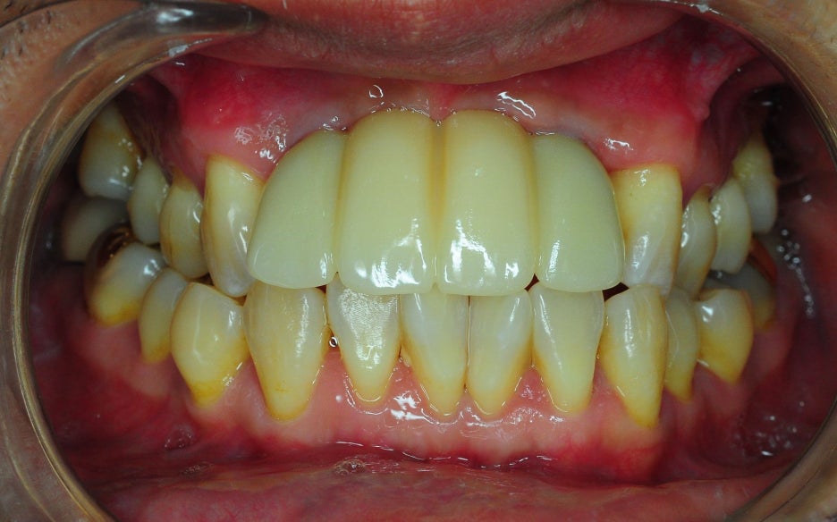 Is Same-Day Implant Possible? What You Must Know Before Implant Surgery image 3