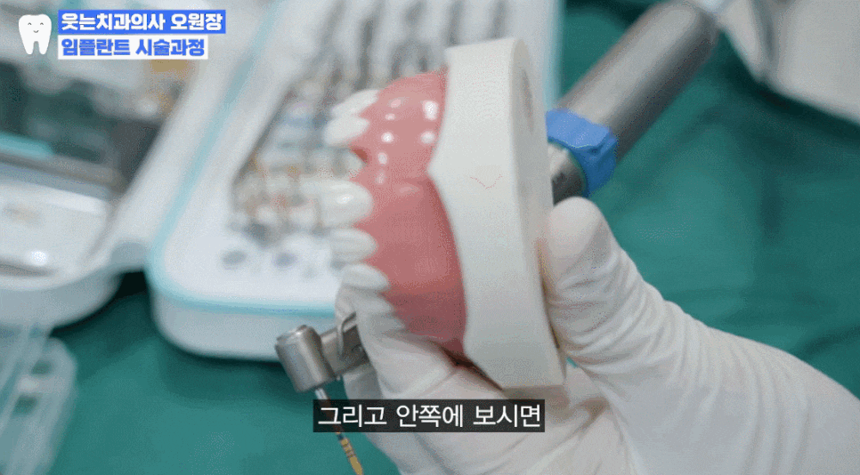 임플란트과정부터 임플란트 치과 고르는 팁까지 A to Z 관련 이미지 11