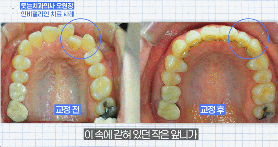 Invisalign Cases: Here’s How Much Can Change Without Brackets image 16