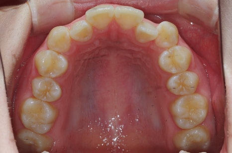 10대 vs 30대 비발치 교정, 얼굴형 변화가 다를 수밖에 없는 이유 관련 이미지 2
