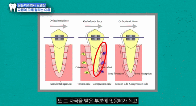돌출입치아교정 기간, 줄일 수 있다고? 관련 이미지 4