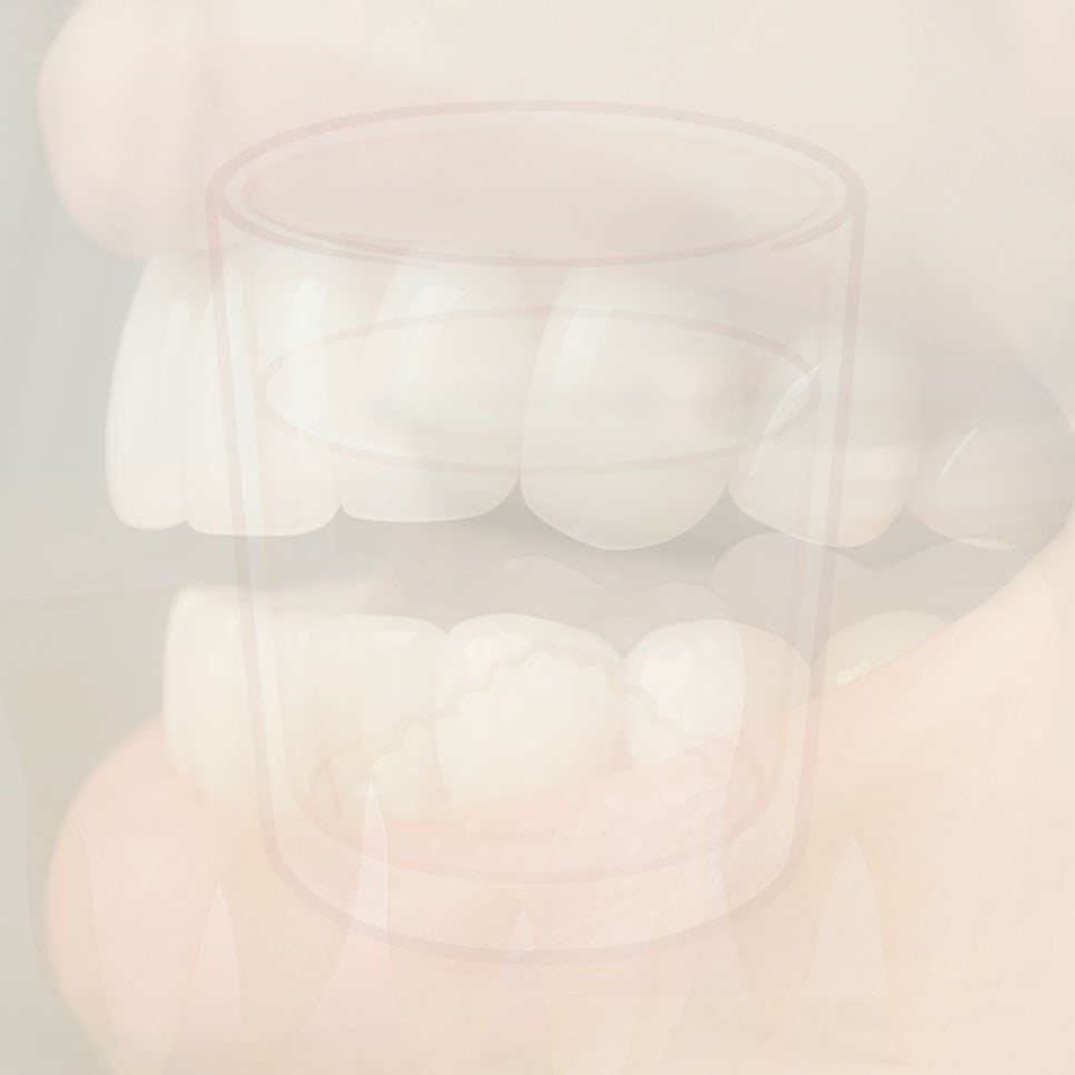 무삭제 라미네이트 후기 꼼꼼히 찾아봤어요 관련 이미지 37