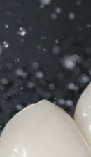 신사역 라미네이트 치과, 자연스러운 미소를 결정짓는 비밀 관련 이미지 30