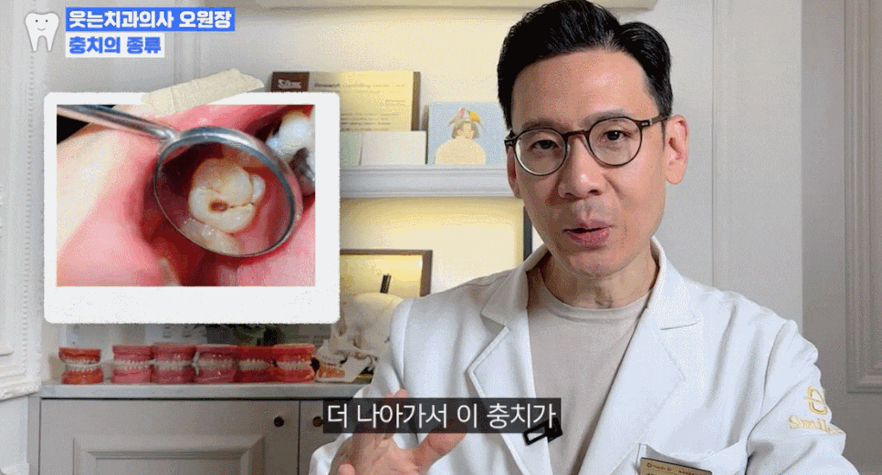 충치 자연치유 어렵기에, 충치단계 치료법 알아두세요 관련 이미지 7