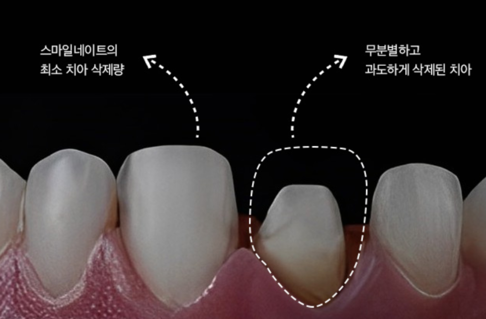 No-Prep Laminates for Teeth: If Done Incorrectly, They Can Make Front Teeth Protrusion Worse image 12