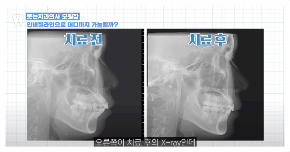 인비절라인 발치 여부에 대한 오해와 진실 알아보기 관련 이미지 16