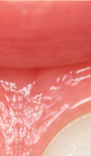 What to Check When Considering No-Prep Laminate Veneers in Gangnam image 26