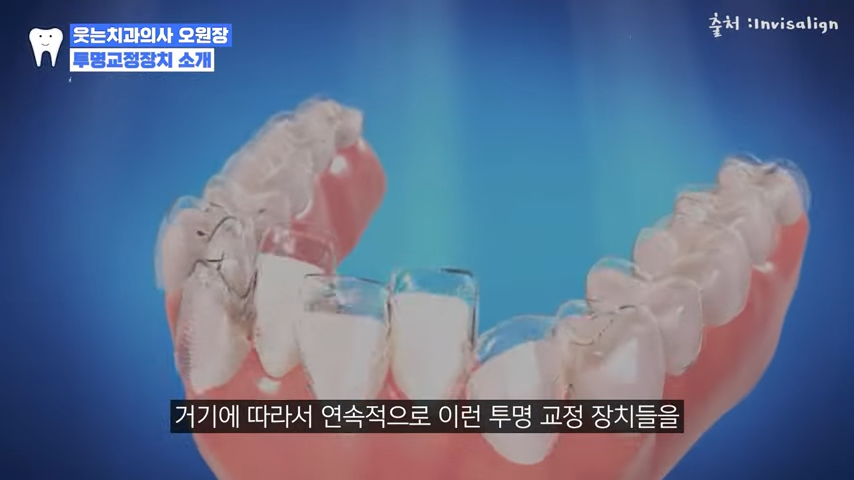 투명교정장치 이런 분들은 효과 없을 수도 있습니다 관련 이미지 5