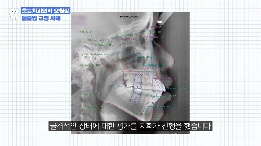 돌출입교정 치과 잘하는 곳은? 4천 건 진료한 의사 TIP 관련 이미지 5