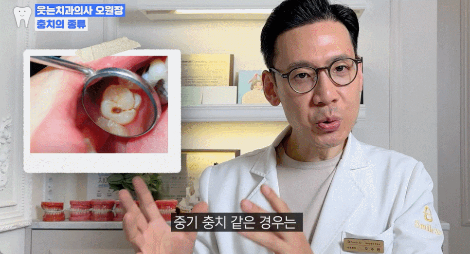 충치 자연치유 어렵기에, 충치단계 치료법 알아두세요 관련 이미지 6