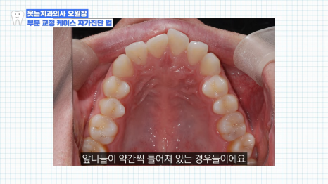 치아교정 앞니부분교정 가능할까? <전문의 답변> 관련 이미지 7