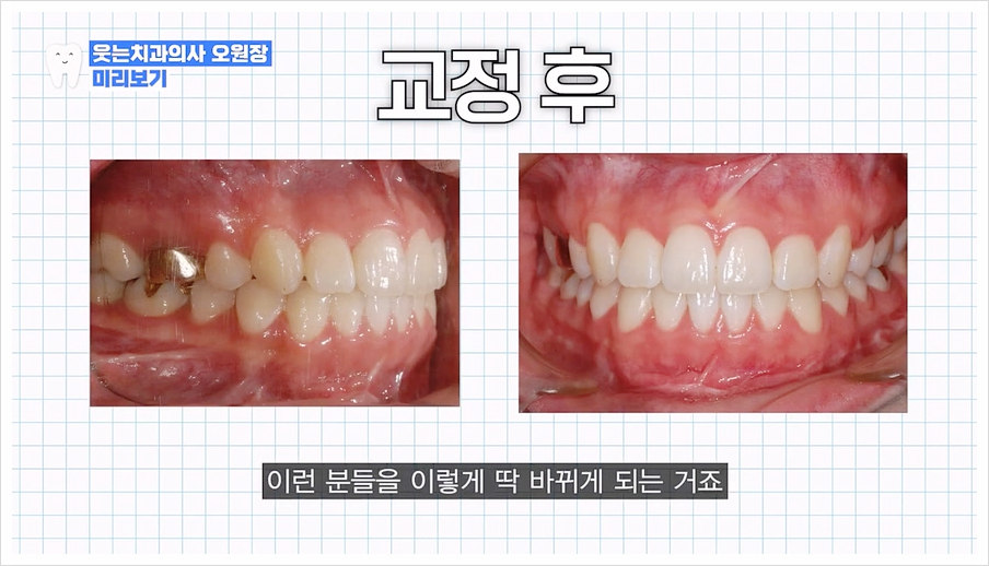 주걱턱 교정 VS 양악수술? 교정과 전문의가 답변드립니다 관련 이미지 23