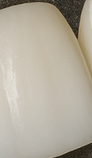 Systematic Examination Process to Review Before Deciding on Front Teeth Laminates image 40