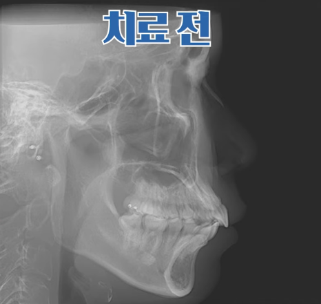 돌출입수술 대신, 인비절라인 돌출입 개선 사례 관련 이미지 9