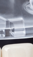 40대 치아 교정 고민 중이라면? 부담 줄이고 효율 높이는 선택법 관련 이미지 40