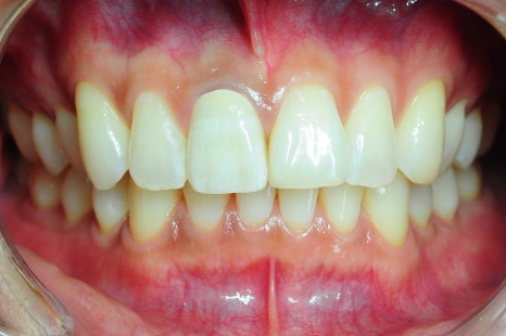 크라운 치료 가격 신경치료 후 크라운 꼭 해야 할까요? 관련 이미지 1