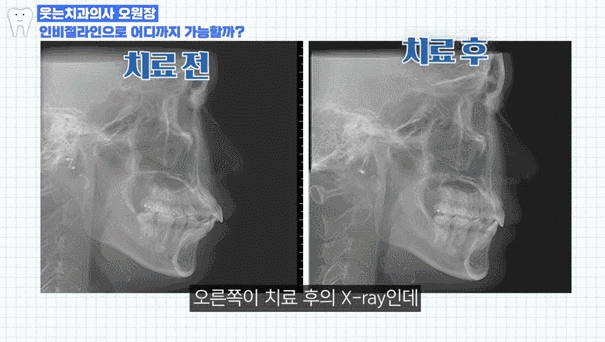투명치아교정, 티 안 나게 가지런해지고 싶다면? 관련 이미지 5