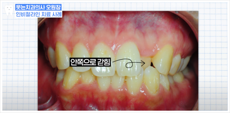 치아 인비절라인 아무도 안 알려주는 솔직한 장단점 (투명교정치과) 관련 이미지 1