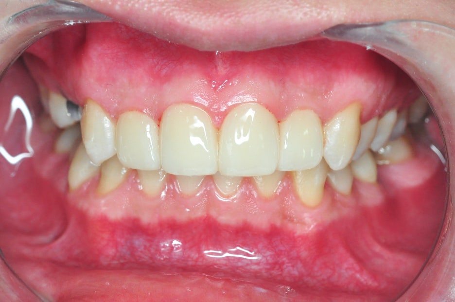 When You Fact-Check the Cost of Laminates and Before-and-After Laminates image 4