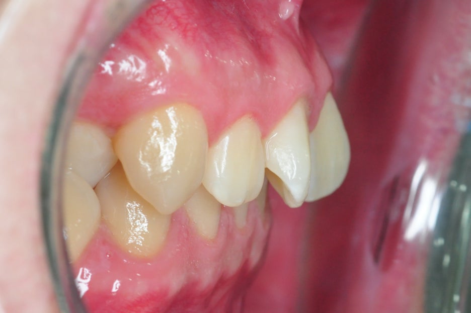 When You Fact-Check the Cost of Laminates and Before-and-After Laminates image 3