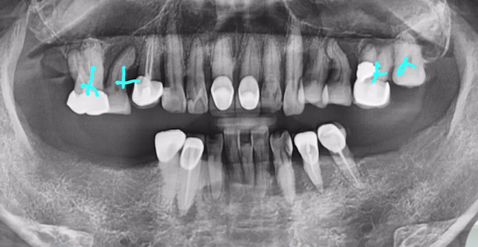 임플란트수술? 발치 즉시 vs 발치 후 임플란트 종류 따져보기 관련 이미지 7