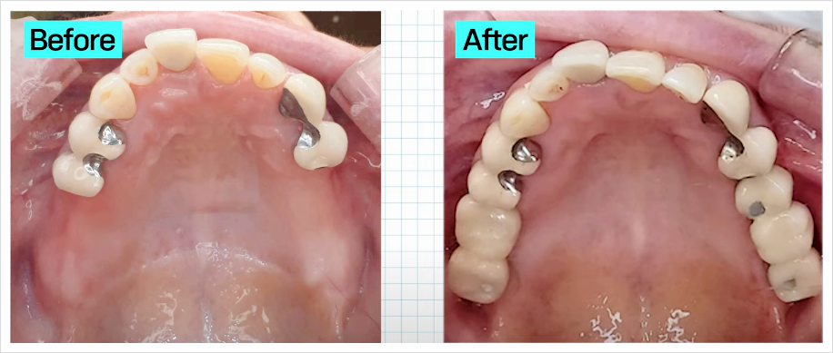 보험임플란트 관련 자주 듣는 질문 전문의가 답변드립니다 관련 이미지 1