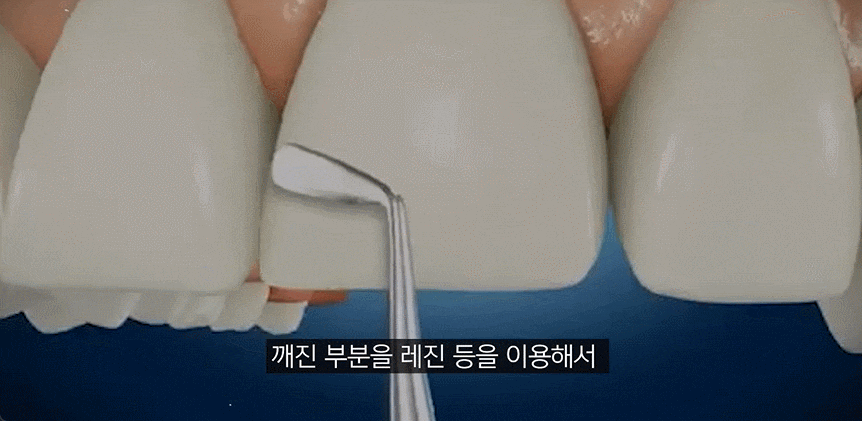 앞니살짝깨짐 빠르게 복원하는 방법 (레진, 라미네이트, 크라운) 관련 이미지 3