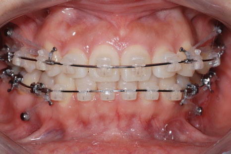 교정후앞니벌어짐, 2년간의 노력이 물거품? 관련 이미지 3