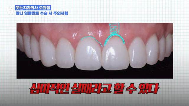 임플란트 OO하게 심으면 가짜 이빨 다 티납니다 관련 이미지 7