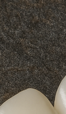 Systematic Examination Process to Review Before Deciding on Front Teeth Laminates image 29