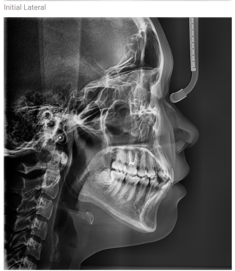 Non-extraction orthodontics? If you have this kind of protruding mouth, orthodontic treatment will not be effective image 17